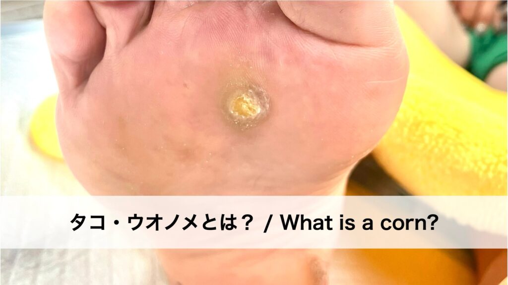 タコ・ウオノメとは？