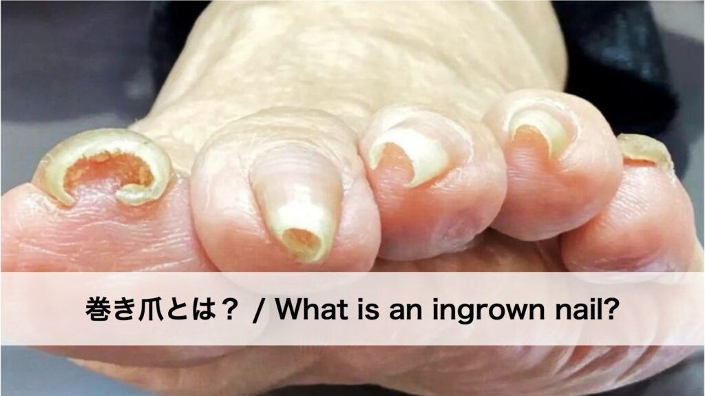 巻き爪・陥入爪とは？