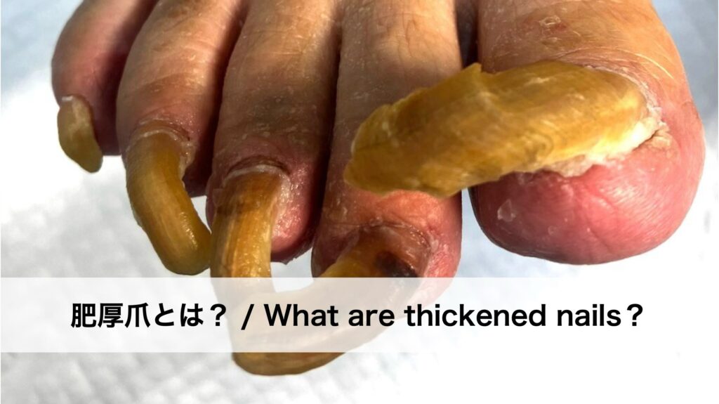 肥厚爪とは?
