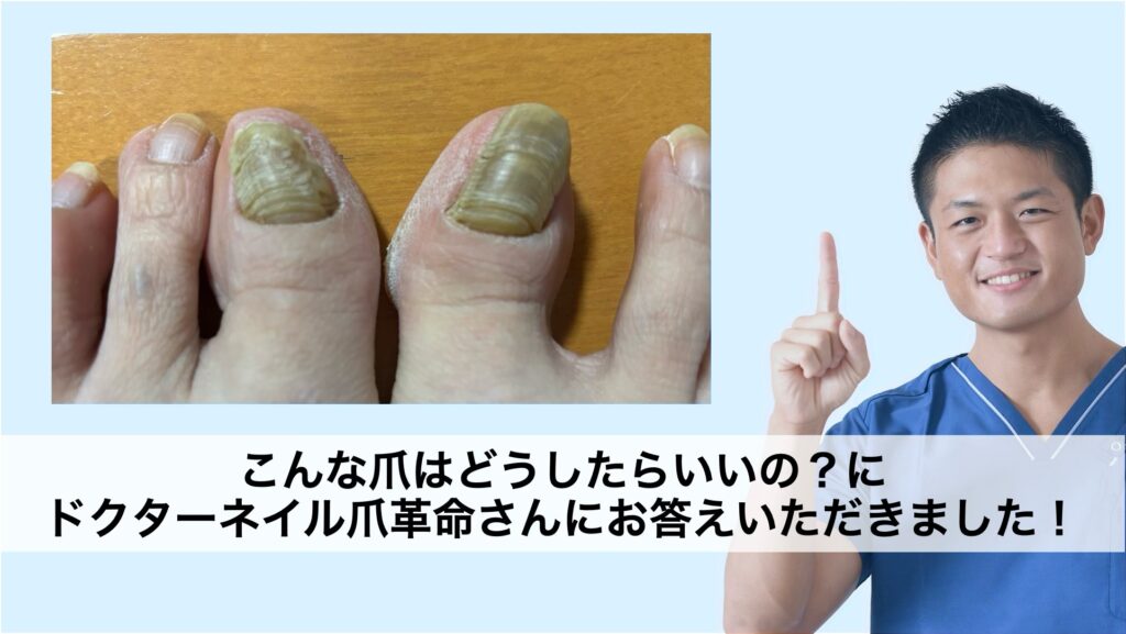 こんな爪はどうしたらいいの？にドクターネイル爪革命さんにお答えいただきました！